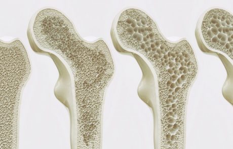 בריחת סידן – בדיקת צפיפות עצם
