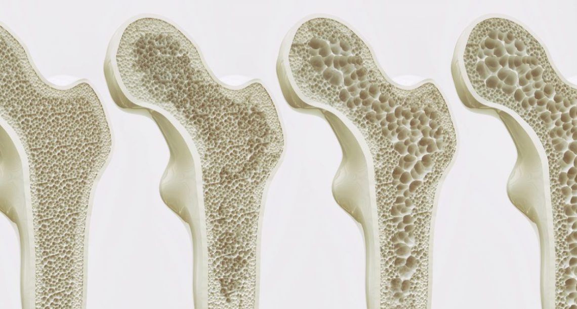 בריחת סידן – בדיקת צפיפות עצם